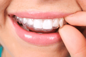 A close-up of a person putting on clear aligners, a treatment for straighter smiles available in Lake Orion, MI.