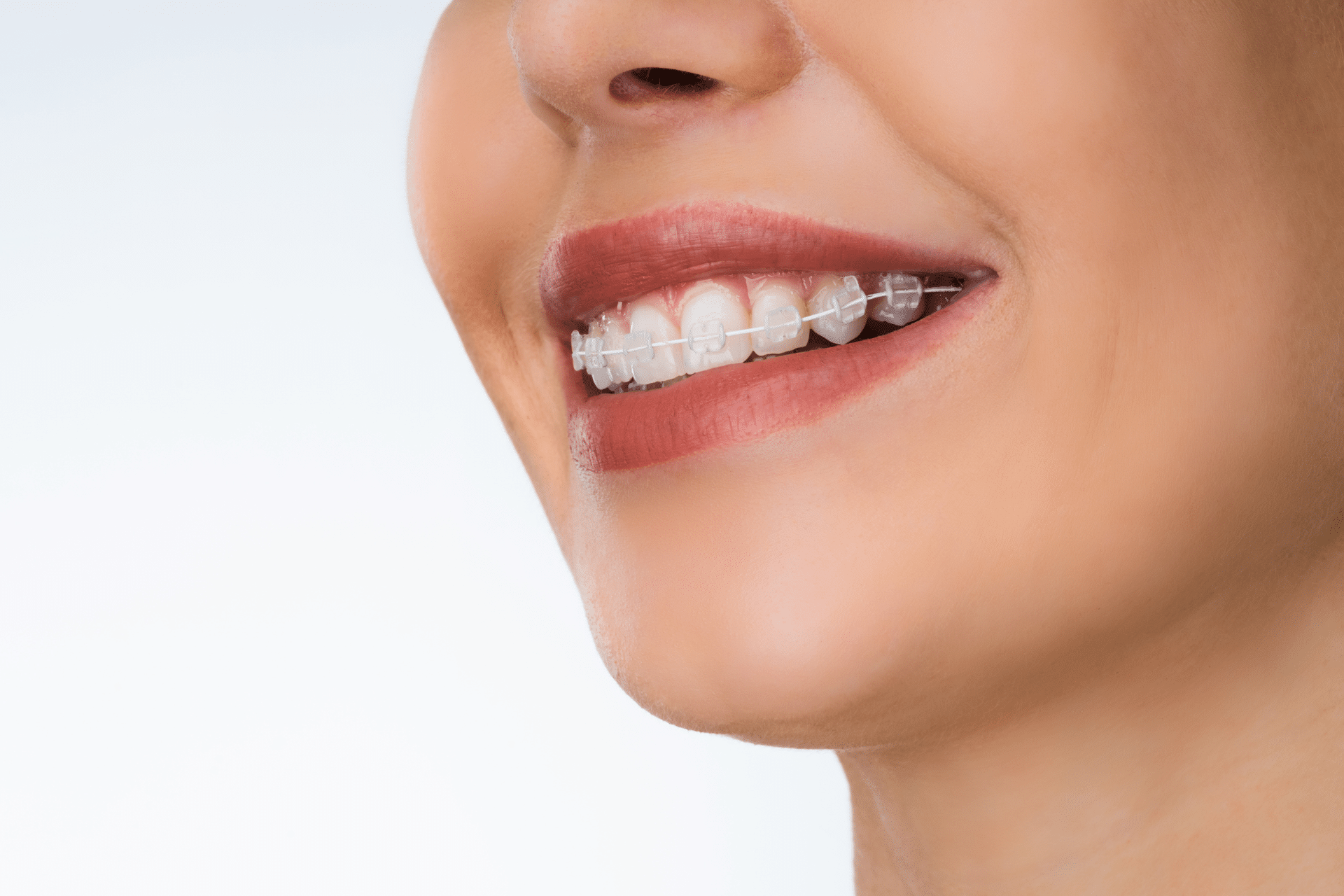 Close-up side view of a person smiling with clear ceramic braces.